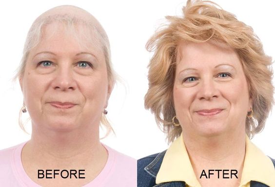 hair loss treatment for women